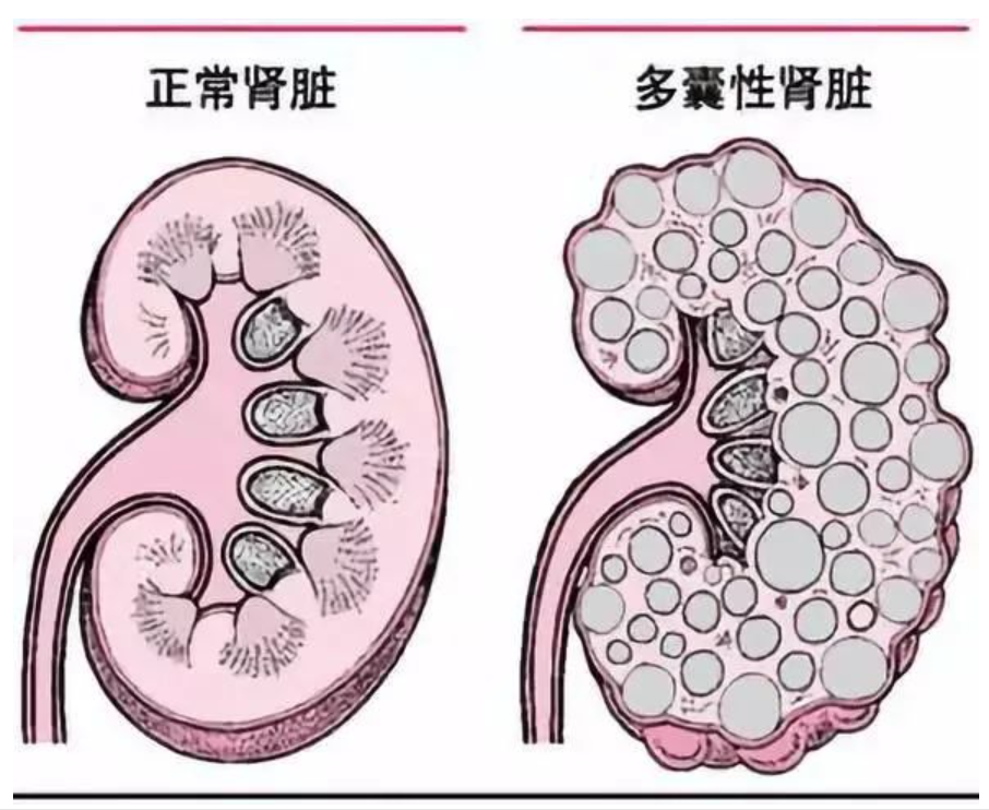 体检查出肾囊肿，危险吗？